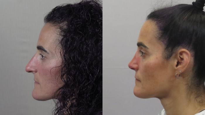 Rhinoplasty Case 1594 Before & After Left Side | Paramus, New Jersey | Parker Center for Plastic Surgery