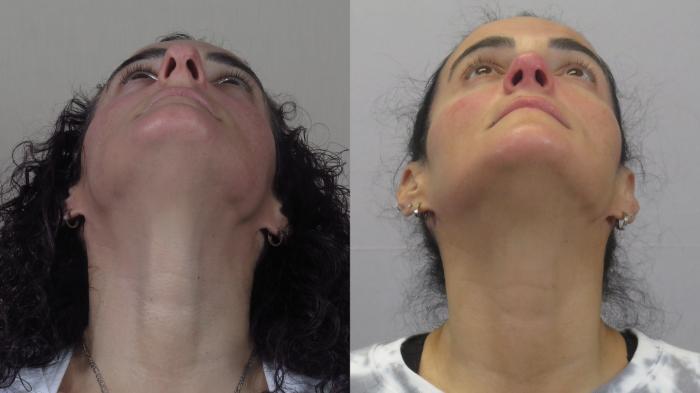 Rhinoplasty Case 1594 Before & After worm's | Paramus, New Jersey | Parker Center for Plastic Surgery