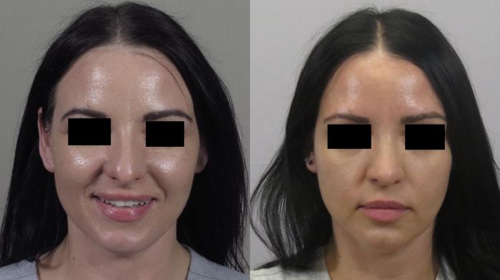 Rhinoplasty Case 1599 Before & After Front | Paramus, New Jersey | Parker Center for Plastic Surgery