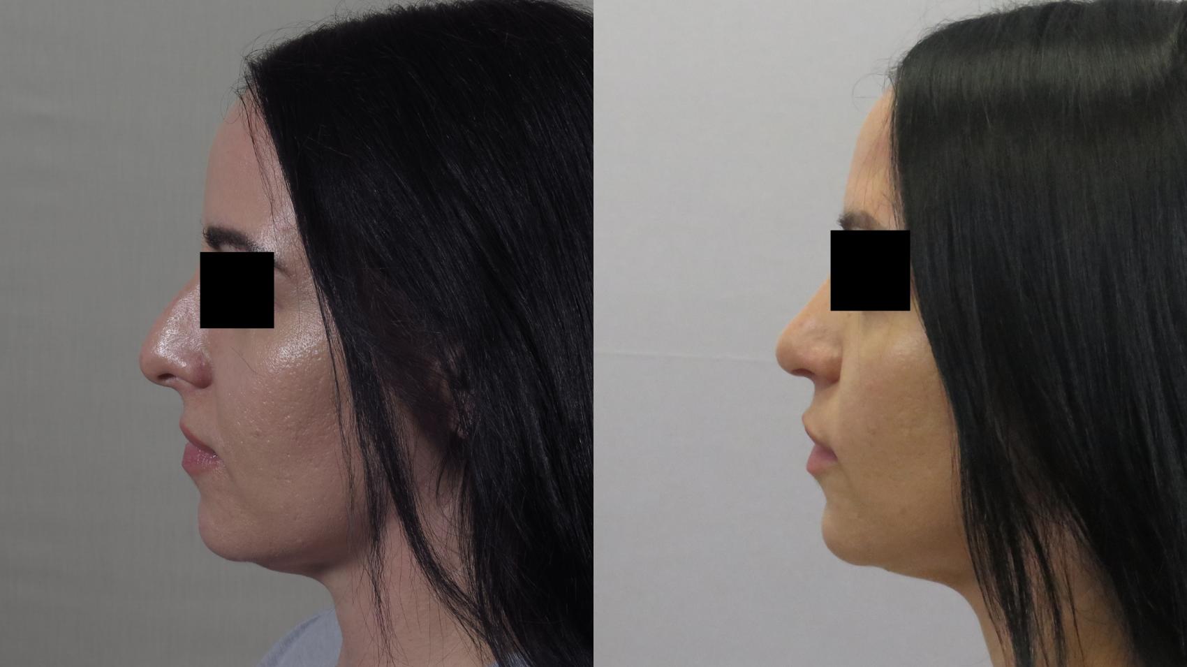 Rhinoplasty Case 1599 Before & After Left Side | Paramus, New Jersey | Parker Center for Plastic Surgery