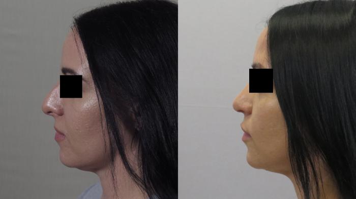 Rhinoplasty Case 1599 Before & After Left Side | Paramus, New Jersey | Parker Center for Plastic Surgery