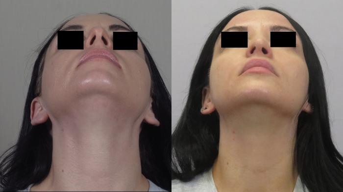 Rhinoplasty Case 1599 Before & After Worm's | Paramus, New Jersey | Parker Center for Plastic Surgery
