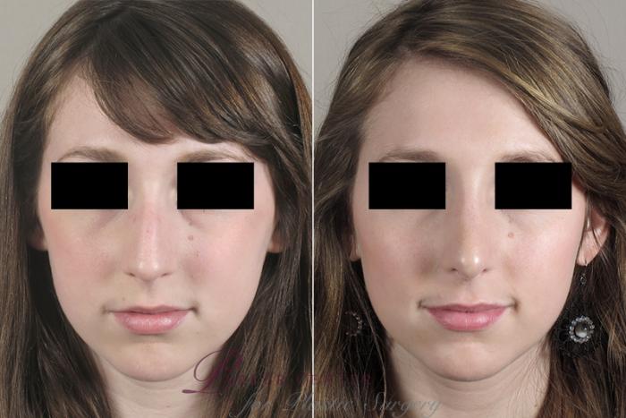 Rhinoplasty Case 160 Before & After View #1 | Paramus, NJ | Parker Center for Plastic Surgery