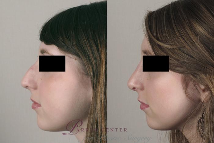 Rhinoplasty Case 160 Before & After View #2 | Paramus, NJ | Parker Center for Plastic Surgery