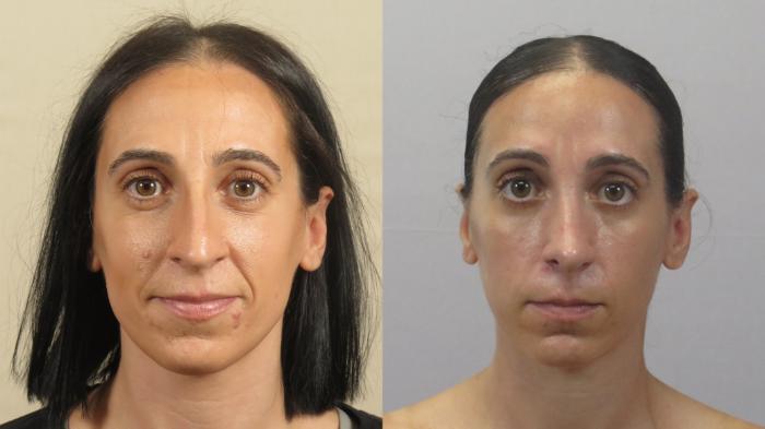 Rhinoplasty Case 1600 Before & After Front | Paramus, New Jersey | Parker Center for Plastic Surgery
