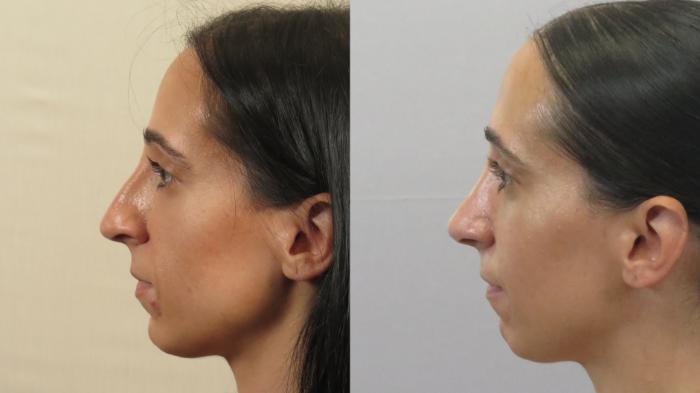 Rhinoplasty Case 1600 Before & After Left Side | Paramus, New Jersey | Parker Center for Plastic Surgery