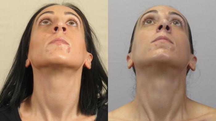 Rhinoplasty Case 1600 Before & After worm's | Paramus, New Jersey | Parker Center for Plastic Surgery