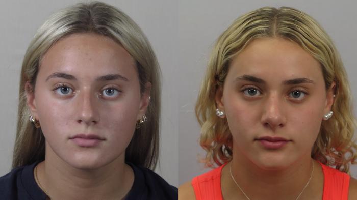 Rhinoplasty Case 1607 Before & After Front | Paramus, New Jersey | Parker Center for Plastic Surgery