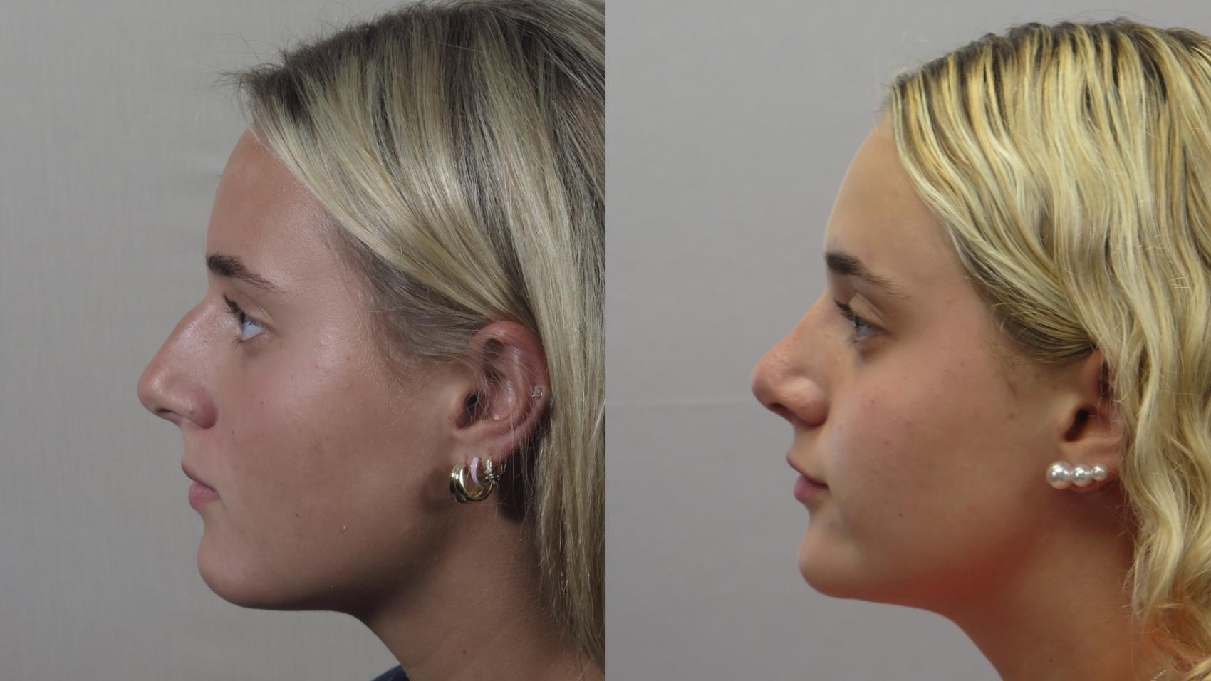 Rhinoplasty Case 1607 Before & After Left Side | Paramus, New Jersey | Parker Center for Plastic Surgery