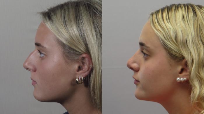 Rhinoplasty Case 1607 Before & After Left Side | Paramus, New Jersey | Parker Center for Plastic Surgery