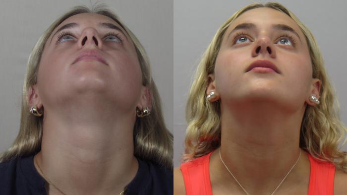 Rhinoplasty Case 1607 Before & After worms | Paramus, New Jersey | Parker Center for Plastic Surgery