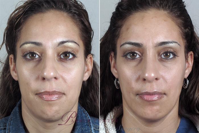 Cheek/Chin Implants Case 161 Before & After View #1 | Paramus, NJ | Parker Center for Plastic Surgery
