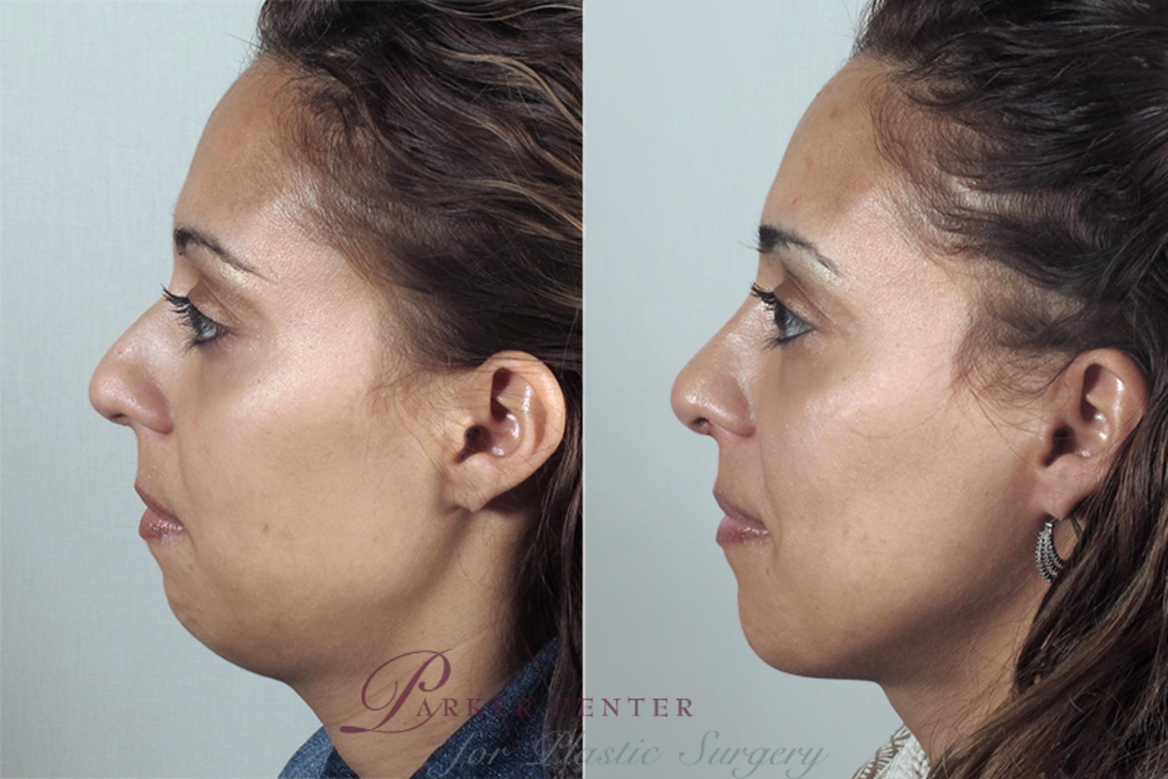 Cheek/Chin Implants Case 161 Before & After View #2 | Paramus, NJ | Parker Center for Plastic Surgery