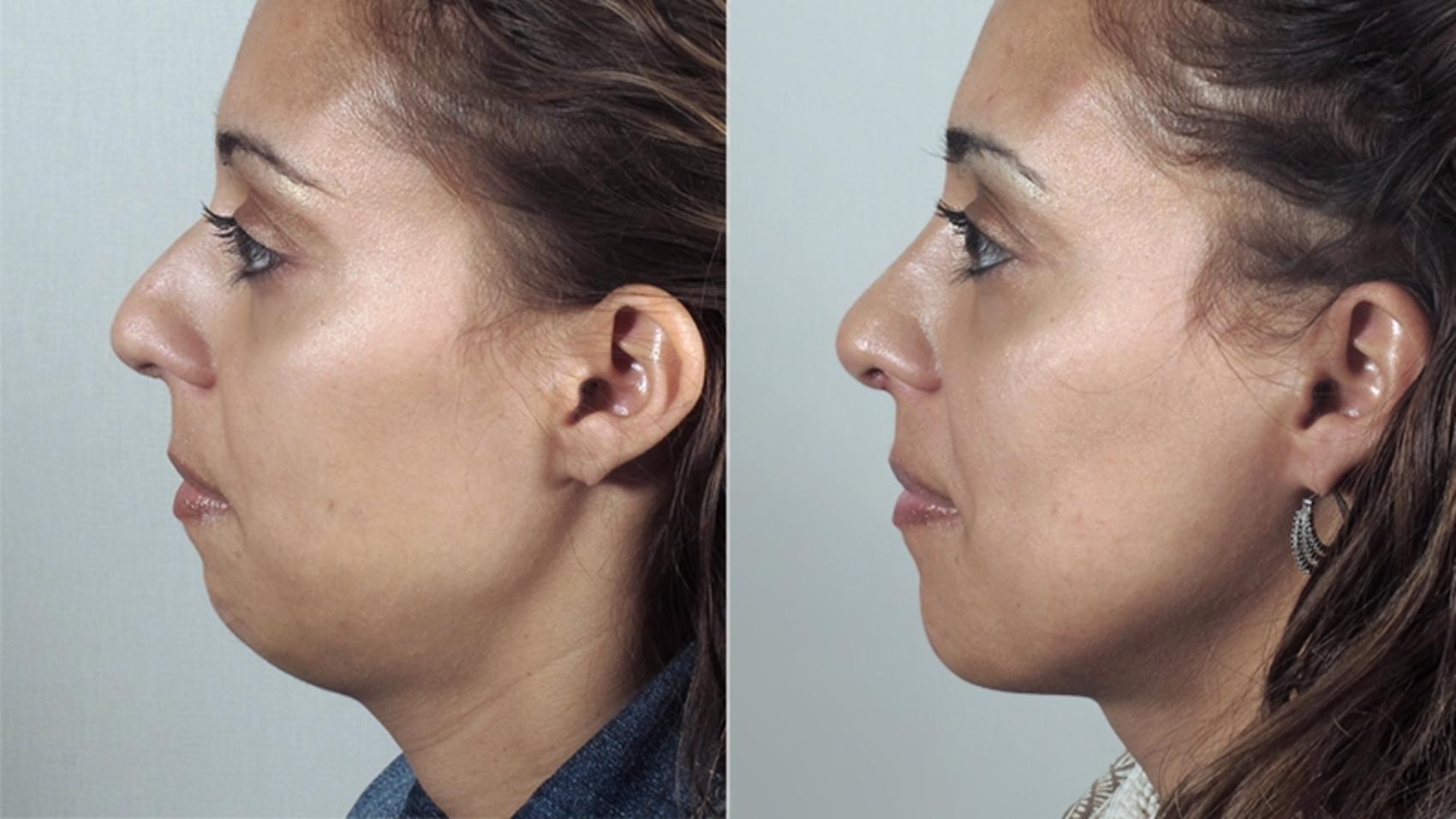 Chin Implants Case 161 Before & After View #2 | Paramus, New Jersey | Parker Center for Plastic Surgery