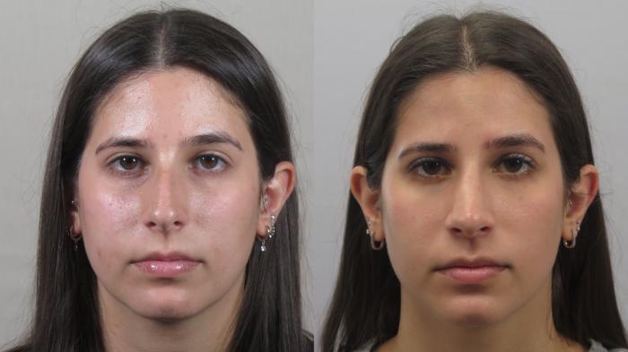 Rhinoplasty Case 1610 Before & After Front | Paramus, New Jersey | Parker Center for Plastic Surgery