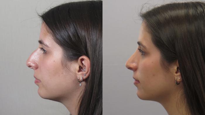 Rhinoplasty Case 1610 Before & After Left Side | Paramus, New Jersey | Parker Center for Plastic Surgery