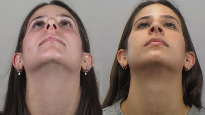 Rhinoplasty Case 1610 Before & After Worms | Paramus, New Jersey | Parker Center for Plastic Surgery