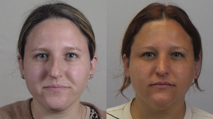 Rhinoplasty Case 1611 Before & After Front | Paramus, New Jersey | Parker Center for Plastic Surgery