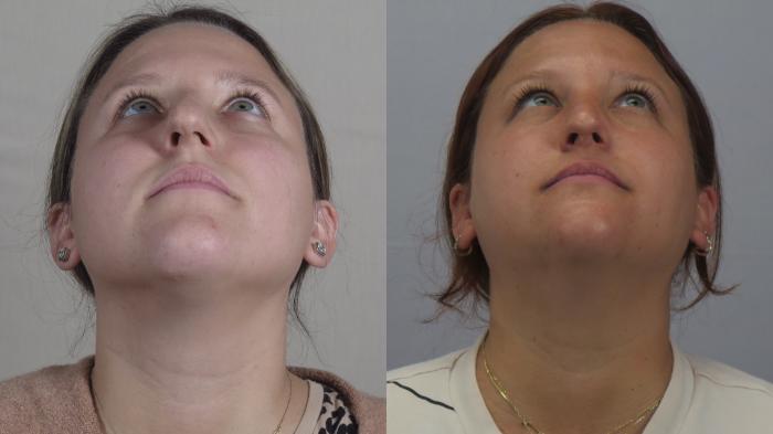 Rhinoplasty Case 1611 Before & After Worm's | Paramus, New Jersey | Parker Center for Plastic Surgery