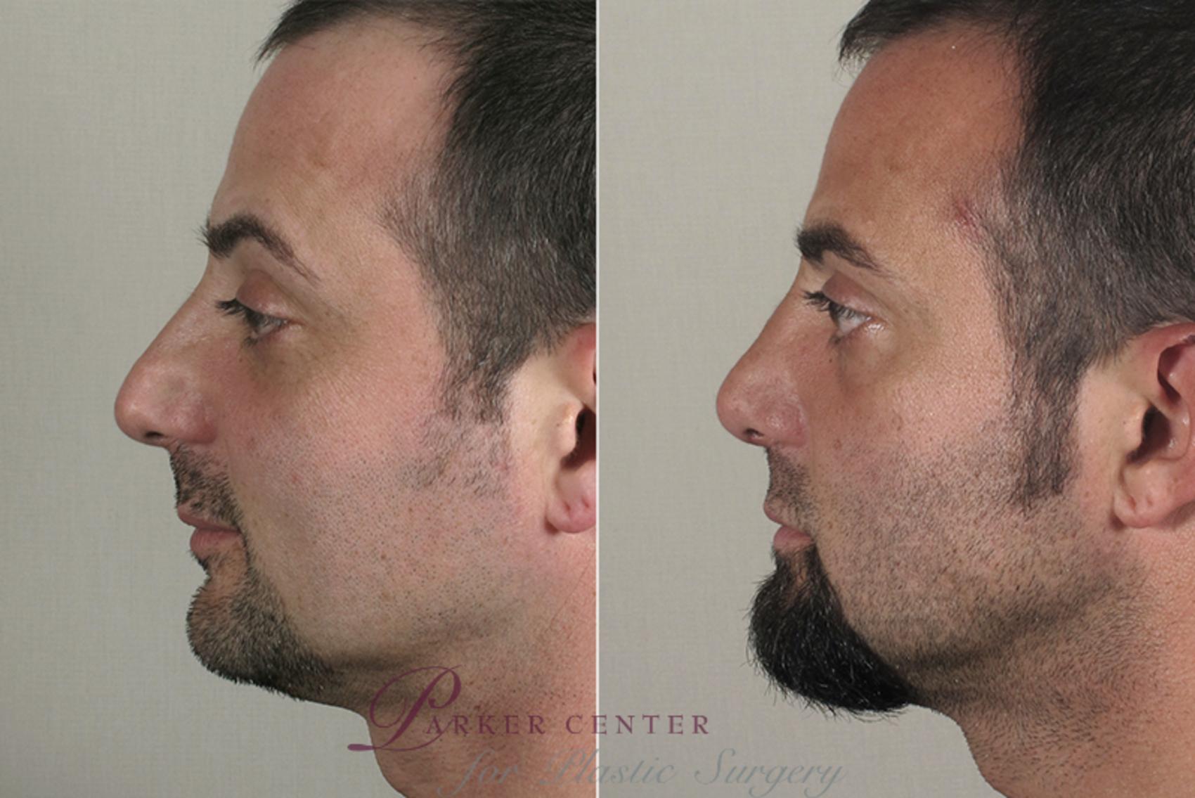 Rhinoplasty Case 162 Before & After View #2 | Paramus, NJ | Parker Center for Plastic Surgery