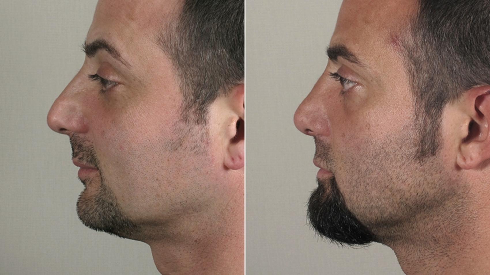 Rhinoplasty Case 162 Before & After View #2 | Paramus, New Jersey | Parker Center for Plastic Surgery