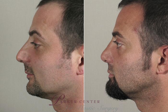 Rhinoplasty Case 162 Before & After View #2 | Paramus, New Jersey | Parker Center for Plastic Surgery