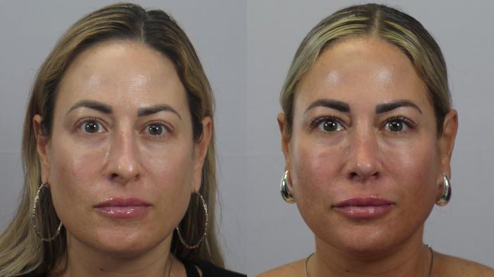 Rhinoplasty Case 1622 Before & After Front | Paramus, New Jersey | Parker Center for Plastic Surgery
