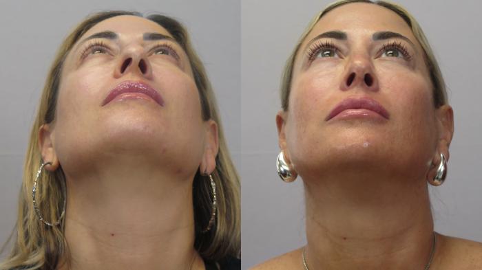 Rhinoplasty Case 1622 Before & After Worms | Paramus, New Jersey | Parker Center for Plastic Surgery
