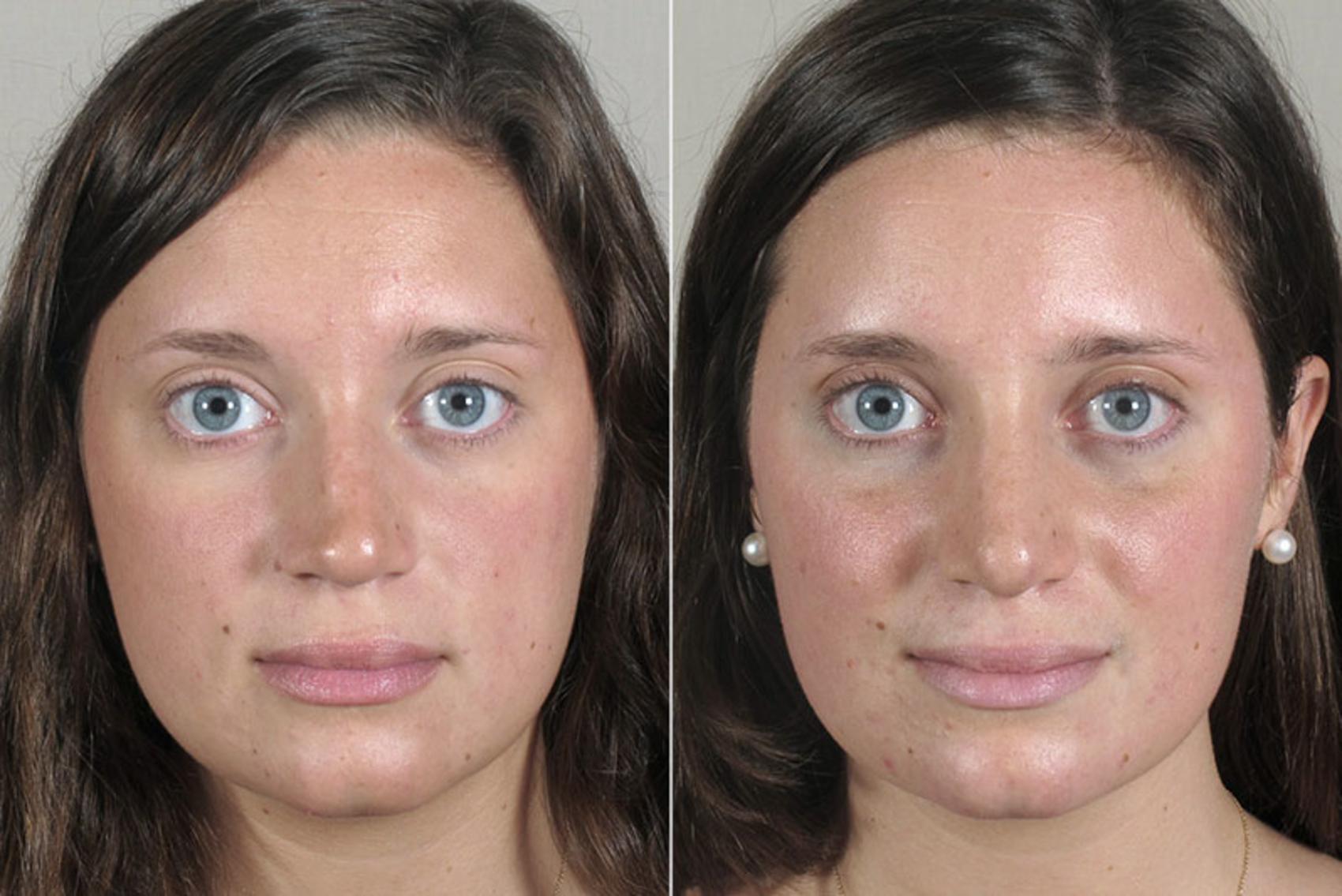 Rhinoplasty Before and After Pictures Case 163 Paramus, New Jersey