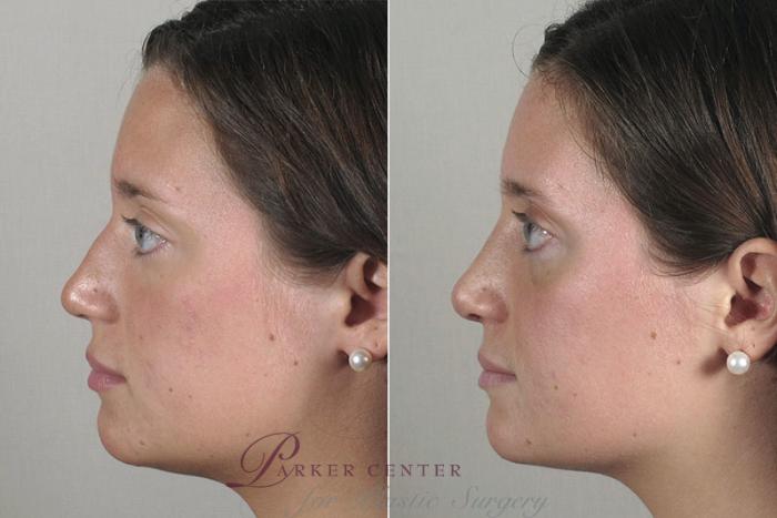 Rhinoplasty Case 163 Before & After View #2 | Paramus, NJ | Parker Center for Plastic Surgery