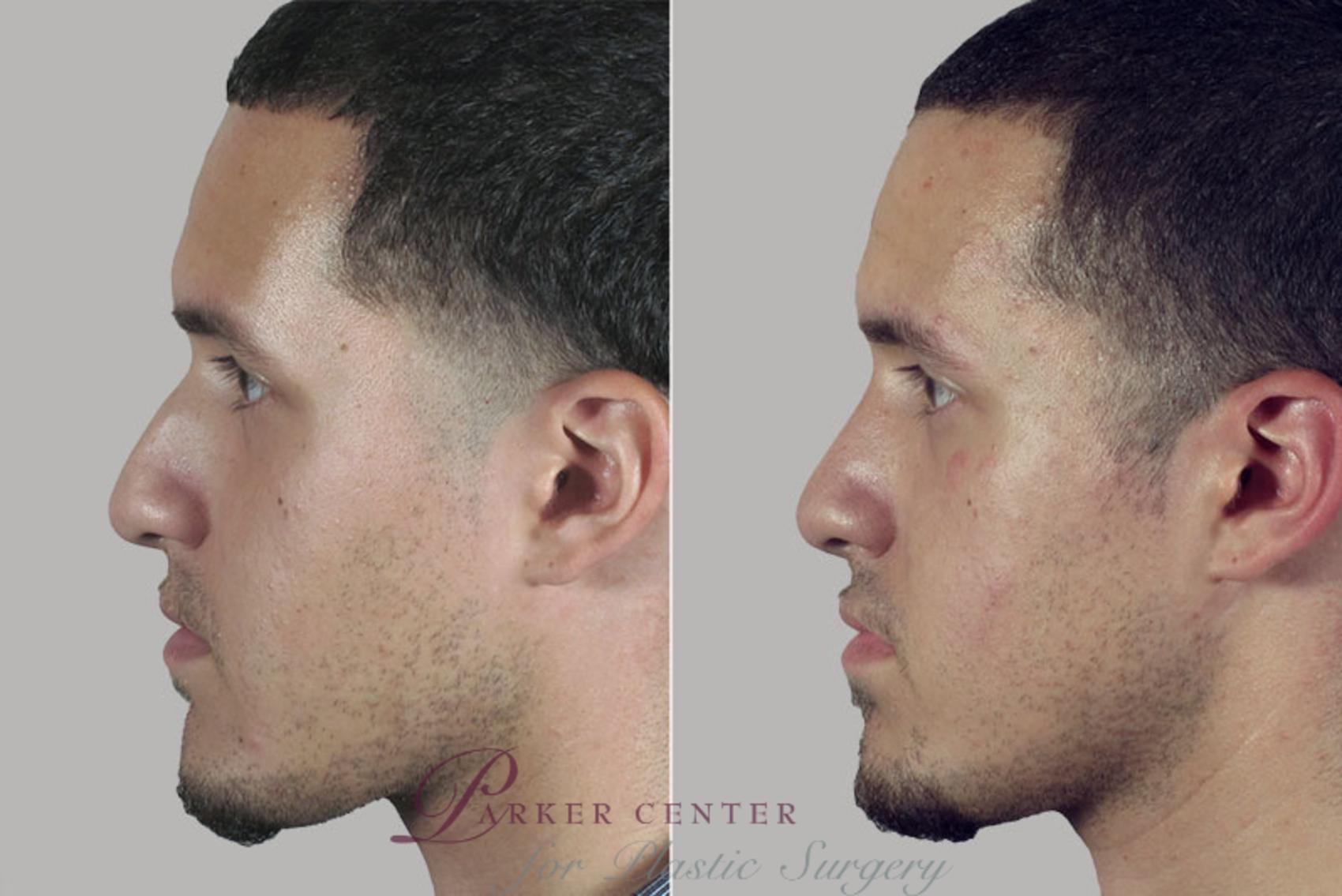 Rhinoplasty Case 164 Before & After View #2 | Paramus, NJ | Parker Center for Plastic Surgery