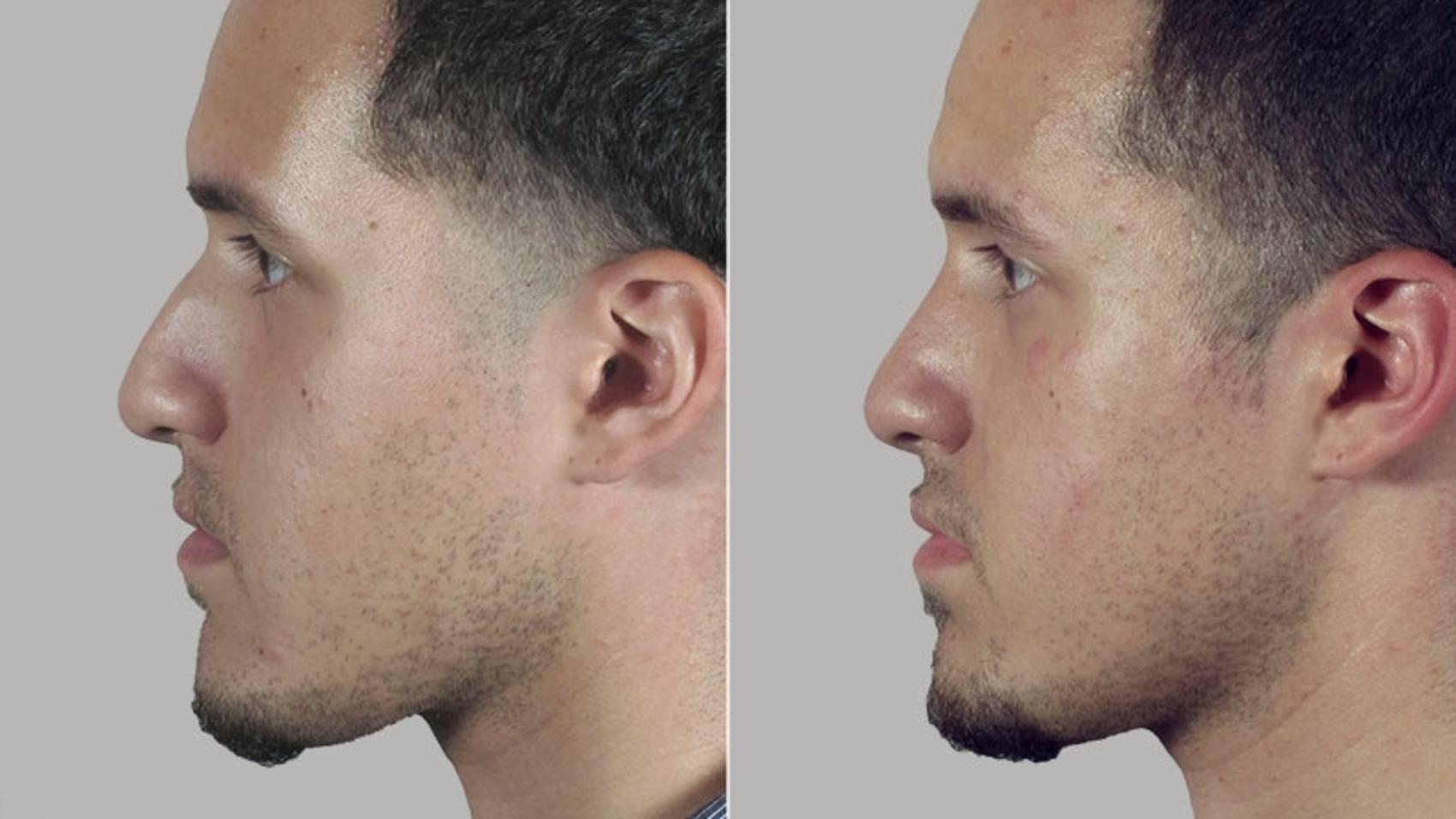 Rhinoplasty Case 164 Before & After View #2 | Paramus, NJ | Parker Center for Plastic Surgery