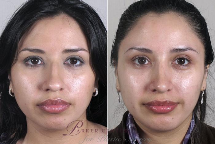 Cheek/Chin Implants Case 165 Before & After View #1 | Paramus, NJ | Parker Center for Plastic Surgery