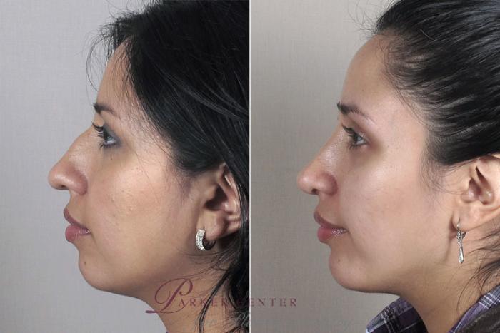 Cheek/Chin Implants Case 165 Before & After View #2 | Paramus, New Jersey | Parker Center for Plastic Surgery