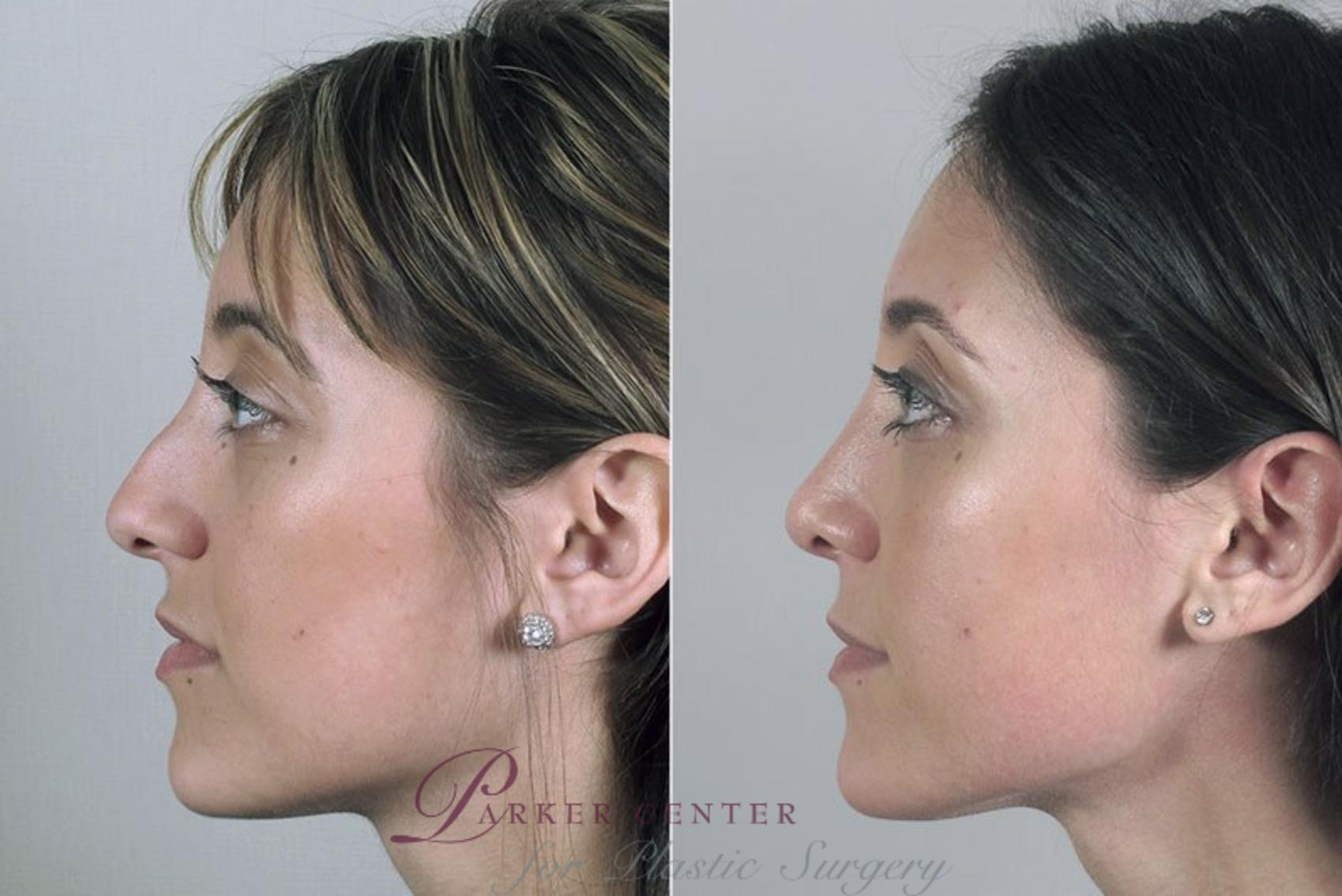 Rhinoplasty Case 166 Before & After View #2 | Paramus, NJ | Parker Center for Plastic Surgery