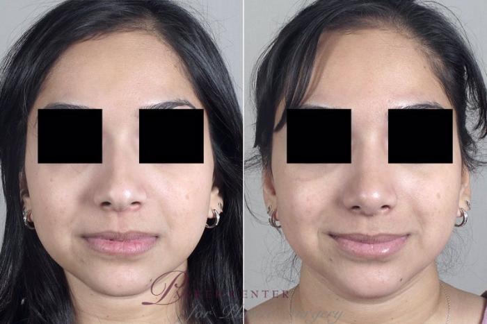 Rhinoplasty Case 167 Before & After View #1 | Paramus, NJ | Parker Center for Plastic Surgery