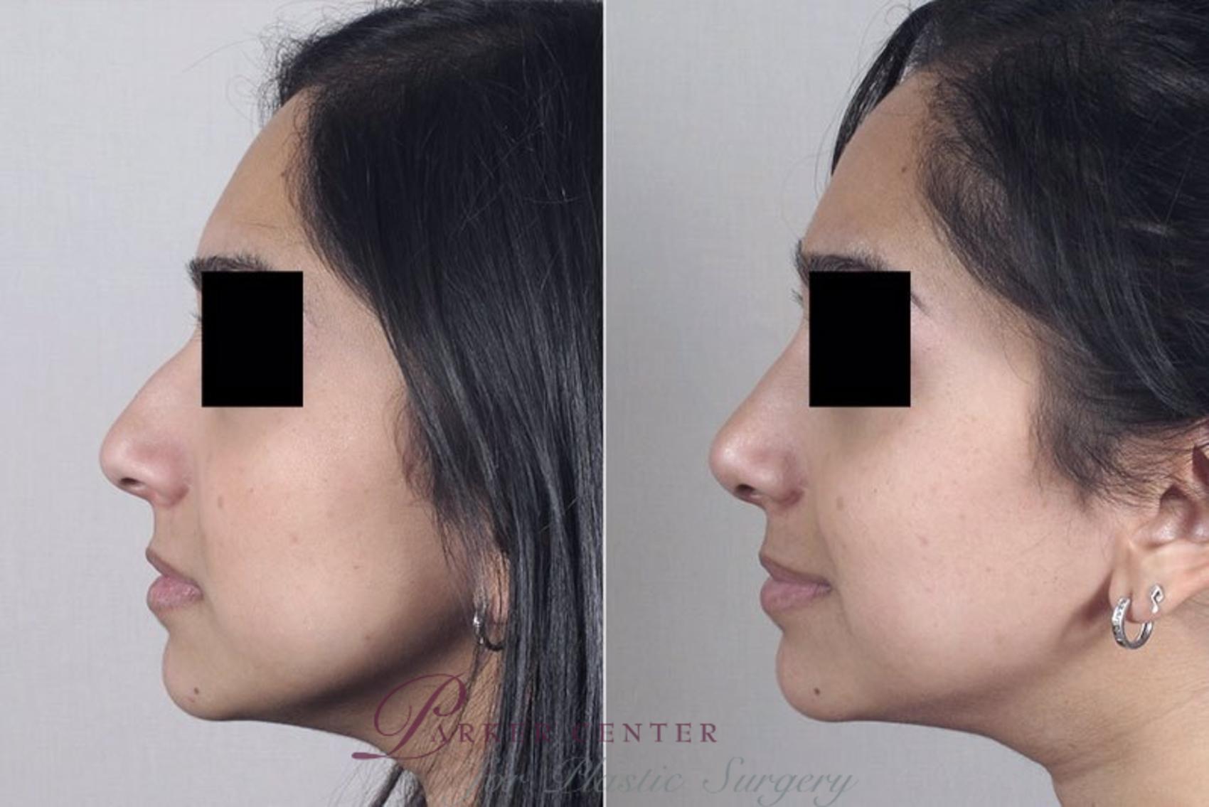 Rhinoplasty Case 167 Before & After View #2 | Paramus, NJ | Parker Center for Plastic Surgery