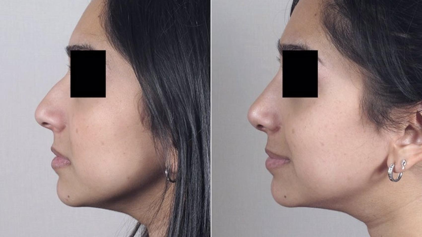 Rhinoplasty Case 167 Before & After View #2 | Paramus, NJ | Parker Center for Plastic Surgery