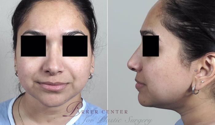 Rhinoplasty Case 167 Before & After View #3 | Paramus, NJ | Parker Center for Plastic Surgery
