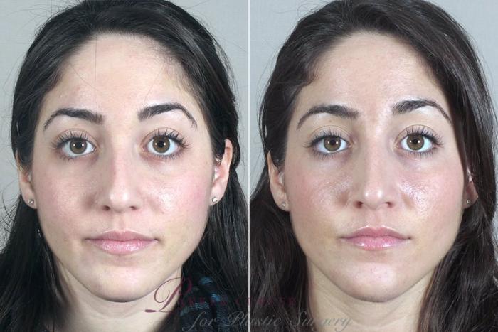 Rhinoplasty Case 168 Before & After View #1 | Paramus, NJ | Parker Center for Plastic Surgery