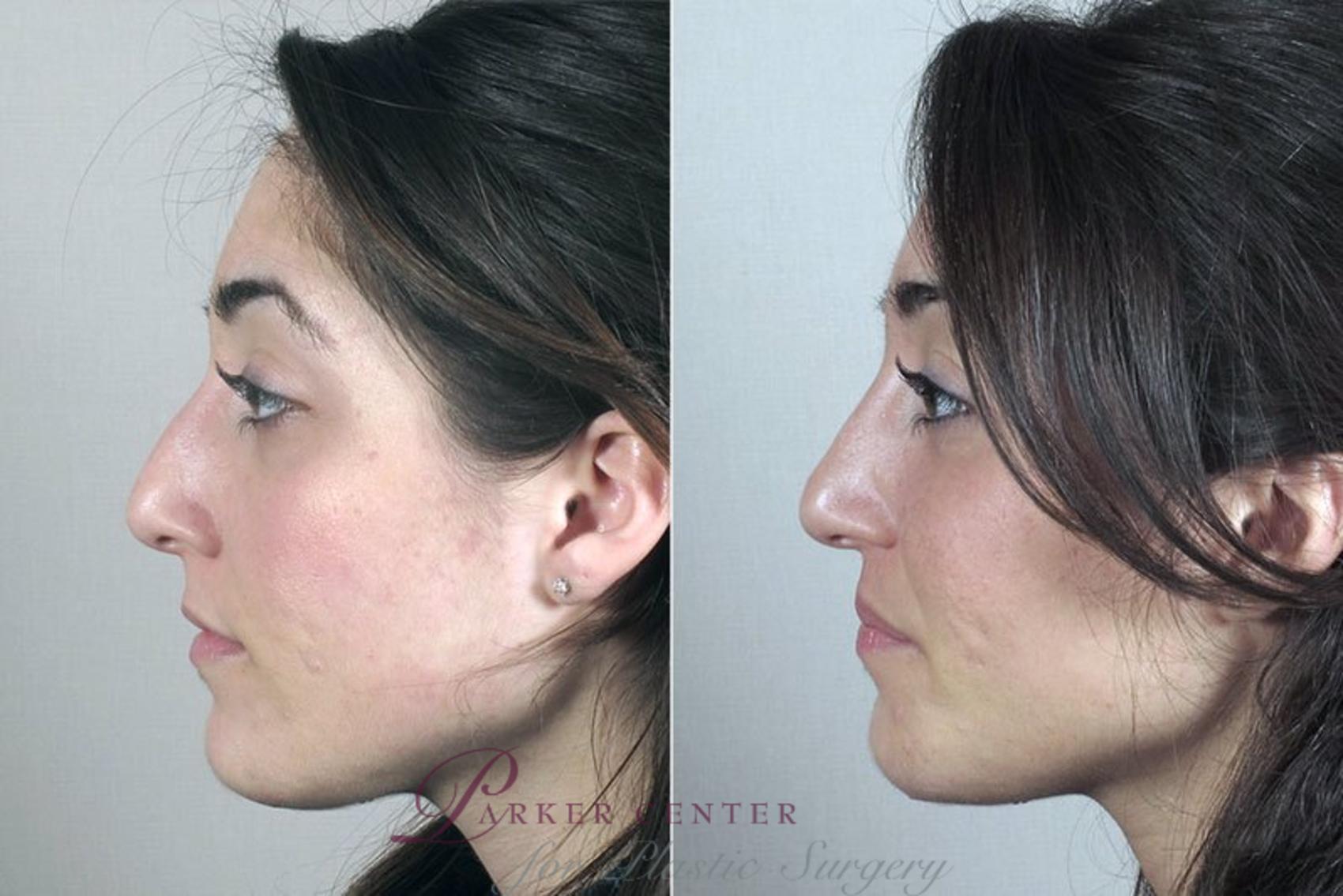 Rhinoplasty Case 168 Before & After View #2 | Paramus, NJ | Parker Center for Plastic Surgery