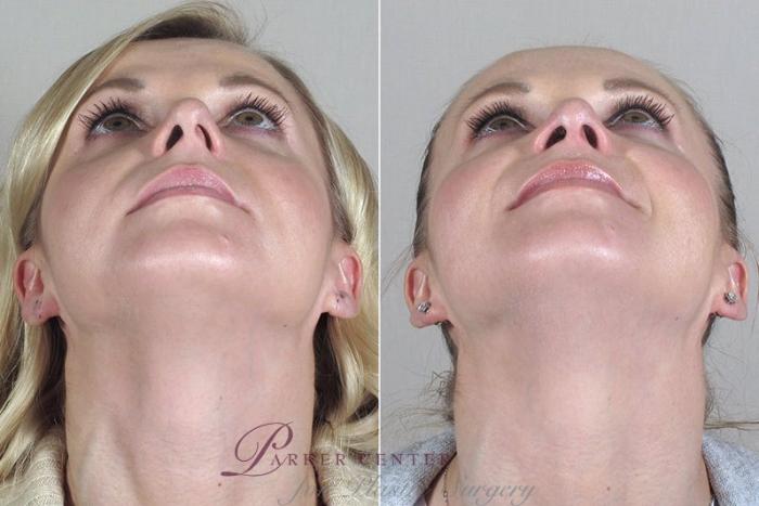 Rhinoplasty Case 169 Before & After View #2 | Paramus, NJ | Parker Center for Plastic Surgery