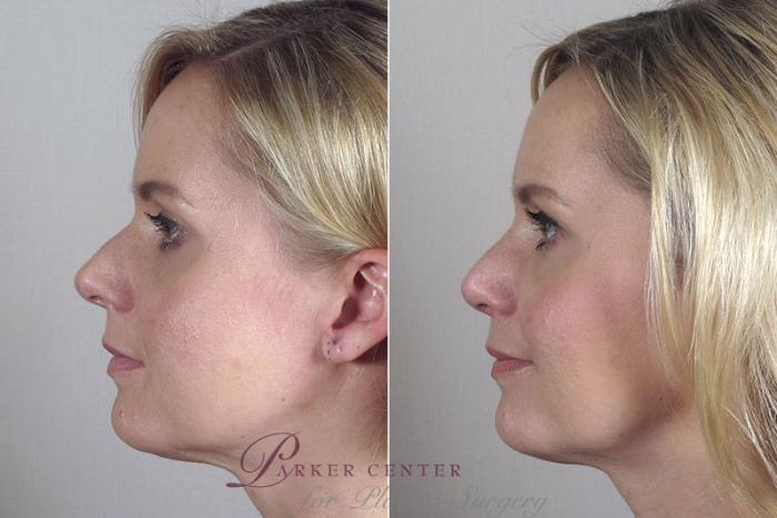 Rhinoplasty Case 169 Before & After View #3 | Paramus, NJ | Parker Center for Plastic Surgery