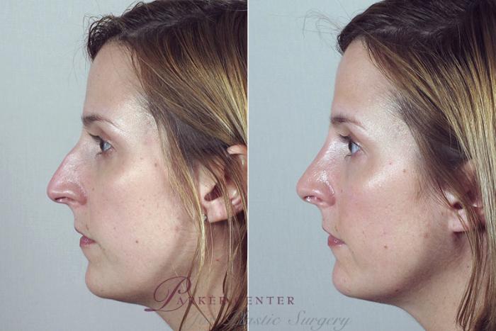 Rhinoplasty Case 170 Before & After View #2 | Paramus, NJ | Parker Center for Plastic Surgery