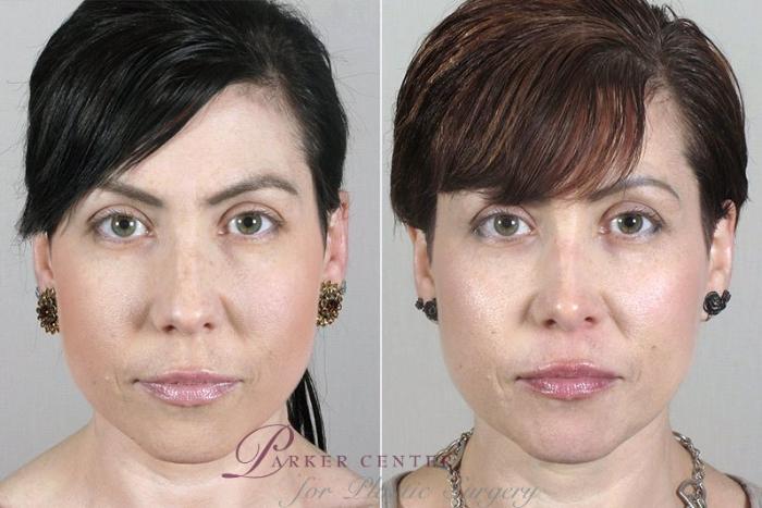 Rhinoplasty Case 171 Before & After View #1 | Paramus, NJ | Parker Center for Plastic Surgery
