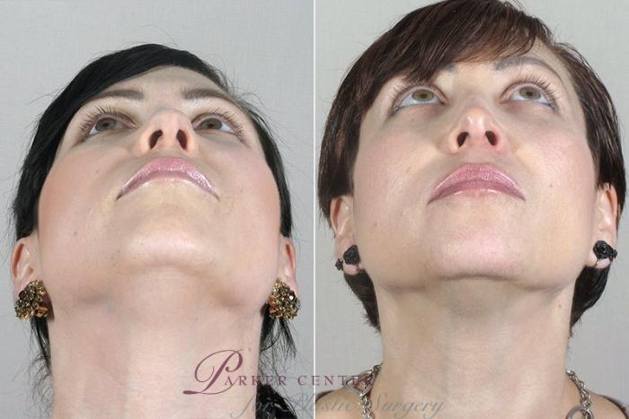 Rhinoplasty Case 171 Before & After View #2 | Paramus, NJ | Parker Center for Plastic Surgery