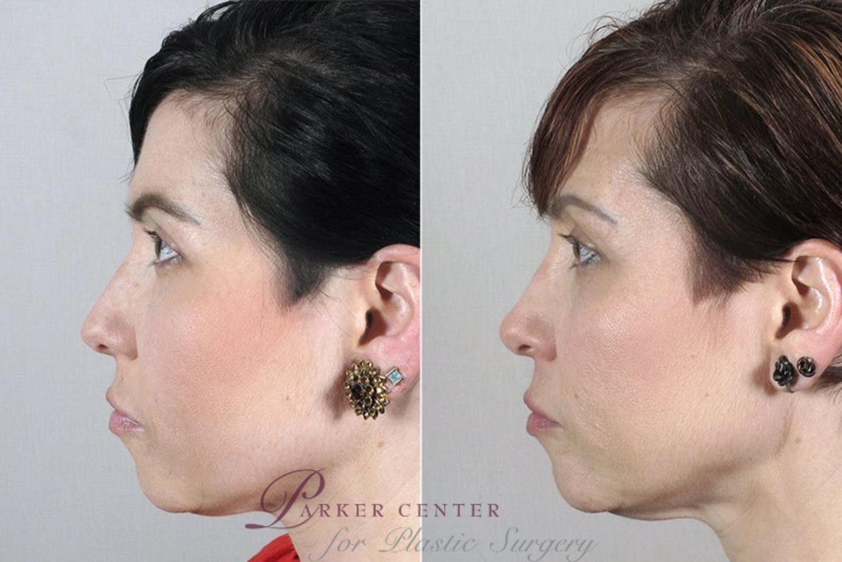 Rhinoplasty Case 171 Before & After View #3 | Paramus, NJ | Parker Center for Plastic Surgery