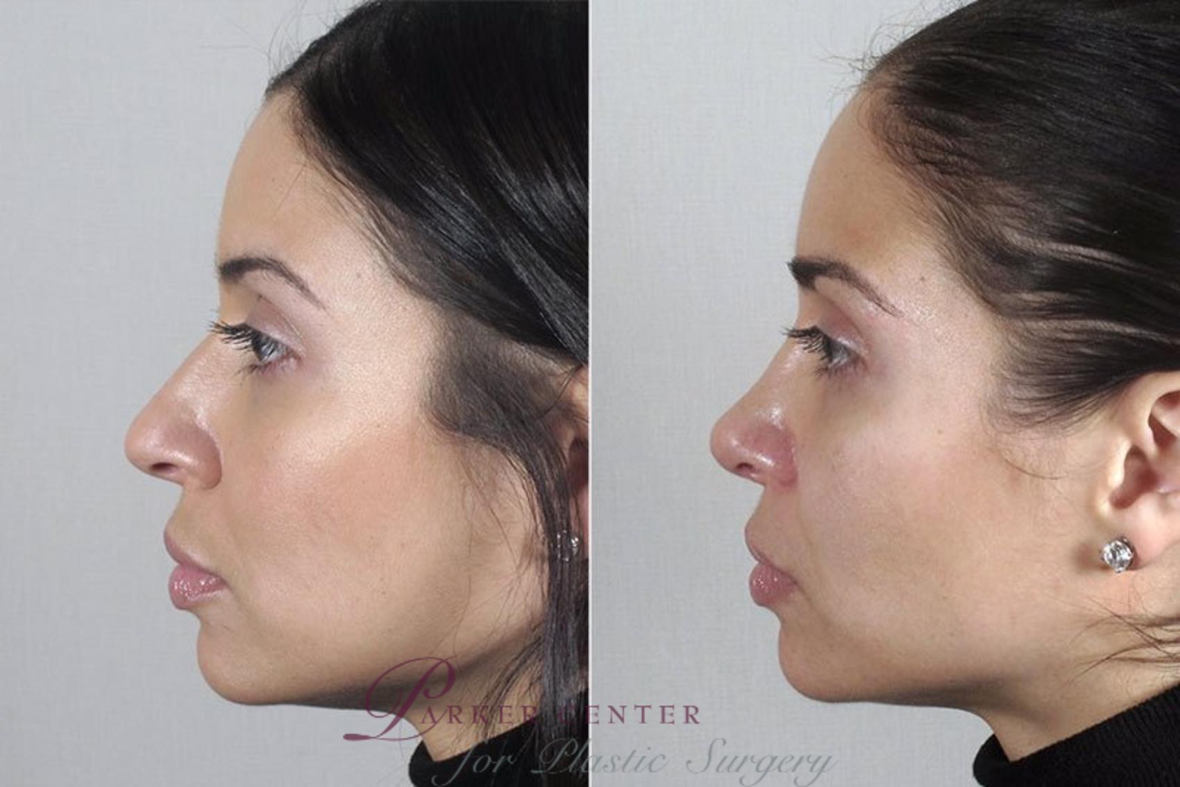 Rhinoplasty Case 172 Before & After View #2 | Paramus, NJ | Parker Center for Plastic Surgery