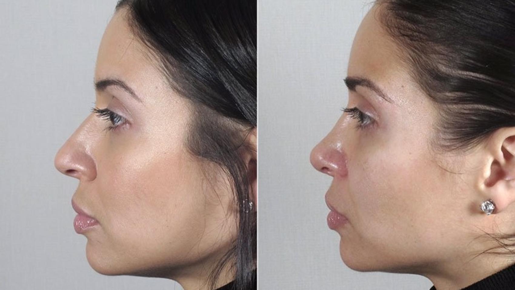 Rhinoplasty Case 172 Before & After View #2 | Paramus, NJ | Parker Center for Plastic Surgery