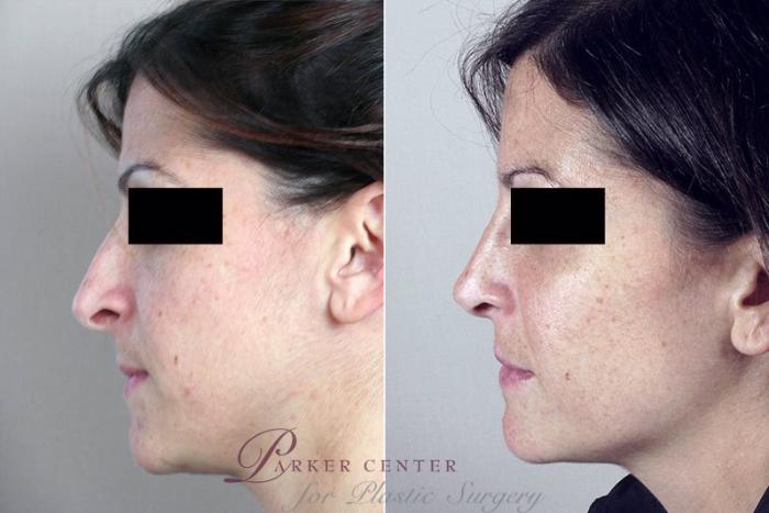 Rhinoplasty Case 173 Before & After View #2 | Paramus, NJ | Parker Center for Plastic Surgery
